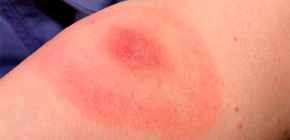 Ce qu'il faut savoir sur les allergies aux piqûres d'insectes