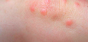 Pommades pour le traitement des piqûres de punaises de lit