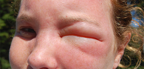 Tumeurs et gonflement avec piqûres d'insectes