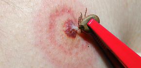 Piqûres de tiques: photos