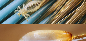 Comment et avec quoi tuer les poux et les lentes sur la tête