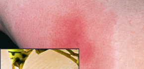 Que faire si une piqûre de guêpe est très irritante