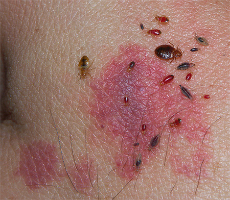 Piqûres de punaises de lit