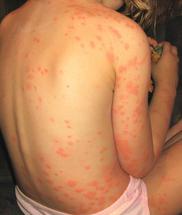 De nombreuses piqûres de punaises de lit