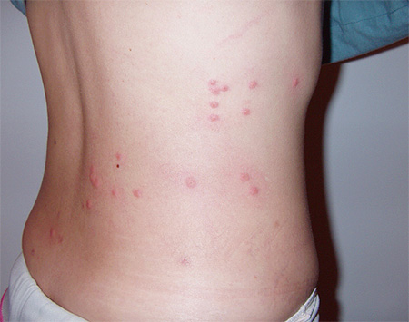 Piqûres de punaises de lit