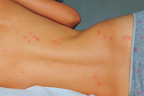 Chemin des piqûres de punaises de lit sur le dos