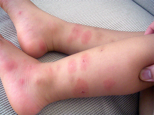 Les punaises de lit piquent les pieds de bébé