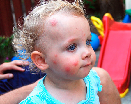 Piqûres de punaises de lit sur le visage