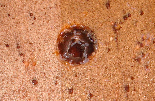 La ponte des punaises de lit