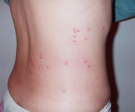 Piqûres de punaises de lit