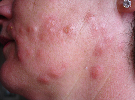 Morsures à la tête