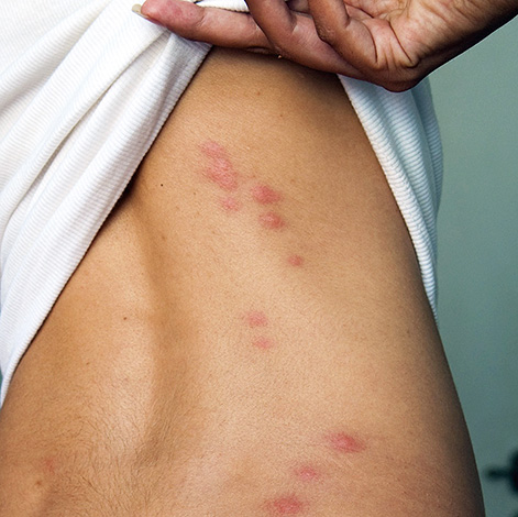 Un exemple de chemins particuliers de piqûres de punaises de lit.