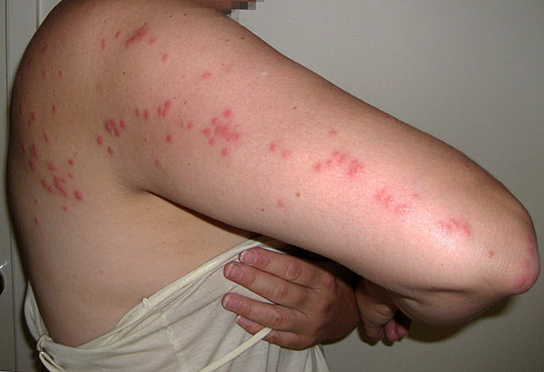 Chaque parasite mord plusieurs fois, à la suite de quoi de tels chemins apparaissent.