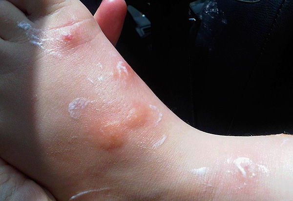 Les punaises de lit piquent la jambe de bébé