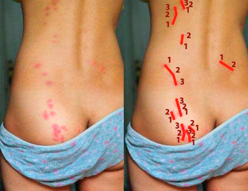 Chemins des piqûres de punaises de lit