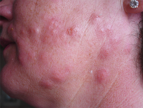 Piqûres de punaises de lit sur le visage