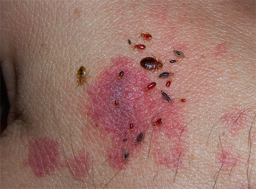 Punaises de lit et leurs larves sur la peau humaine
