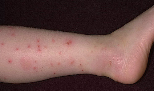 Piqûres de puces sur la jambe