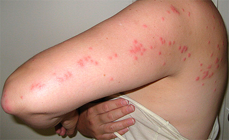 De nombreuses piqûres de punaises de lit