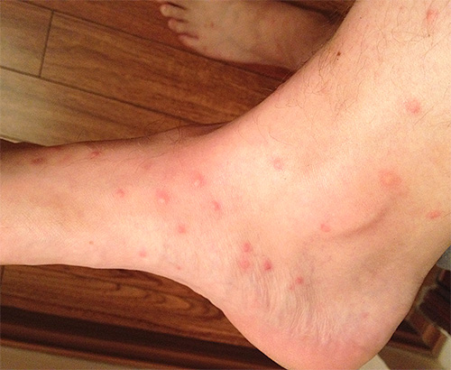 Marques de piqûres de puces fraîches