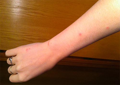 Marques de piqûres de puces après quelques heures