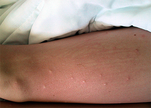 Photo de piqûres de puces peignées