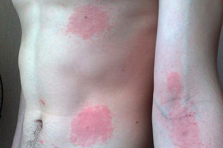 Dermatophilose