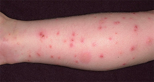 De nombreuses piqûres de puces