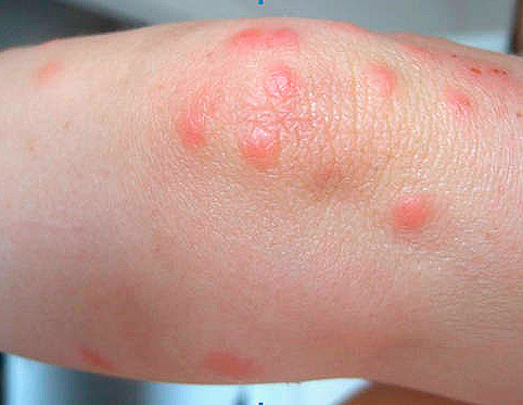 Voyons quelle pommade peut être utilisée pour les piqûres de punaises de lit