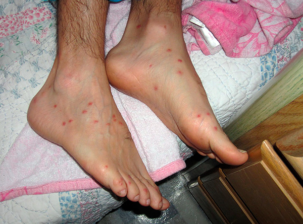 Si de telles piqûres sont peignées, il existe un risque d'introduction d'une infection dans la plaie.