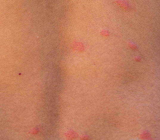Piqûres de puces dans le dos