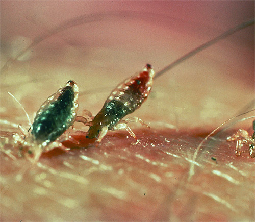 L'une des croyances populaires dit que les poux vivent sous le cuir chevelu dans des bosses spéciales et sortent pendant le stress.