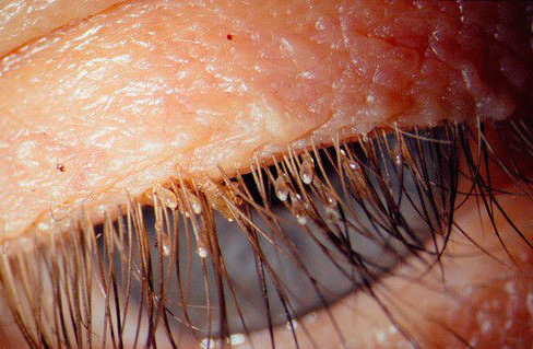 Et voici à quoi ressemblent les lentes sur les cils humains