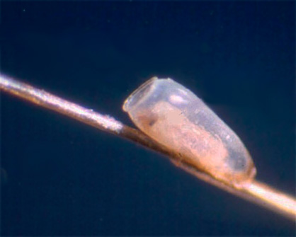 Des lentes vides laissées sur les cheveux après que les larves de poux en sont sorties