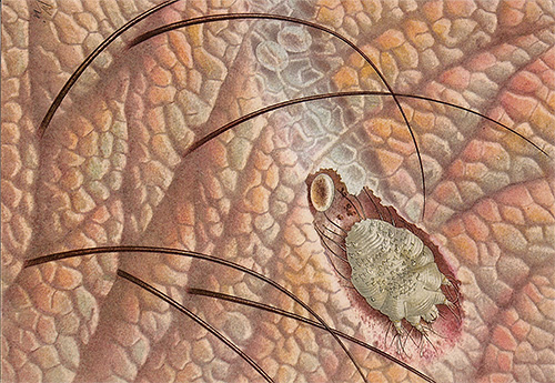 L'agent causal de la gale, l'acarien de la gale, ne peut être vu sans microscope.