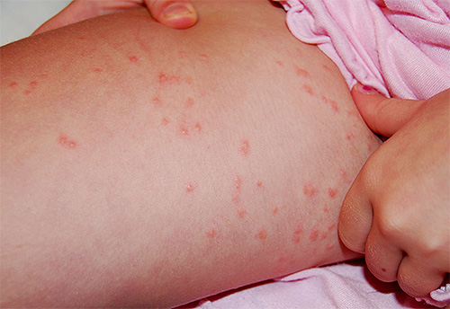 Les poux de lit piquent à l'intérieur de la cuisse