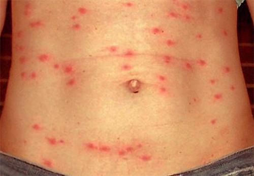 Manifestations du typhus sur la peau de l'abdomen