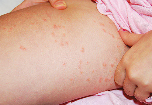 Les poux de lin piquent dans la région de la cuisse