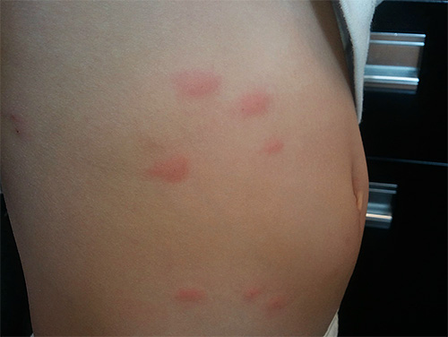 Rougeur sur la peau aux endroits des piqûres de poux