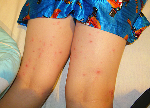 Marques de piqûres de poux