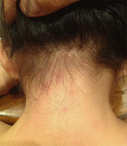 Les piqûres de poux peuvent entraîner non seulement des éruptions cutanées allergiques chez un enfant, mais également provoquer des maladies plus graves.