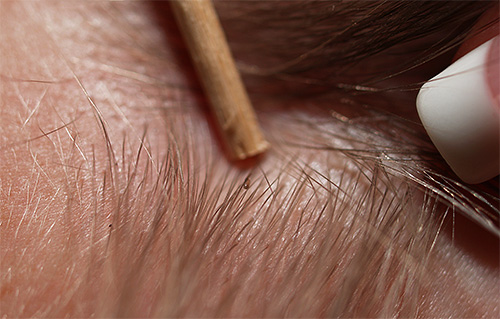 Pour détecter les poux, vous devez d'abord examiner attentivement les cheveux de l'enfant.