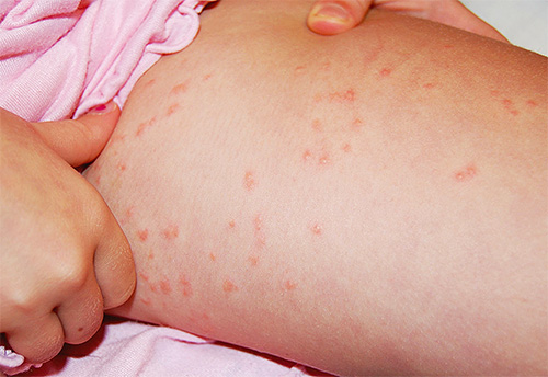 Les poux de lin piquent dans la région de la cuisse