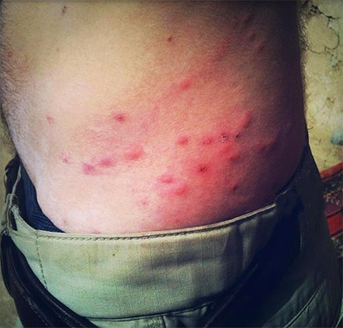 Piqûres de puces d'orignal