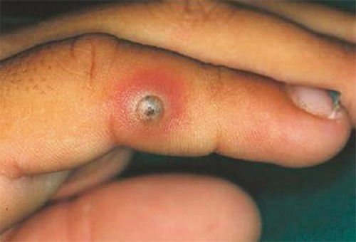 Sur la photo - la piqûre d'une puce de sable