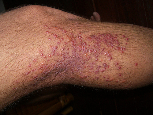 Piqûres multiples de puces de sable