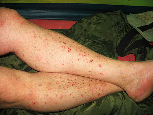 Jambes couvertes de piqûres de puces de sable