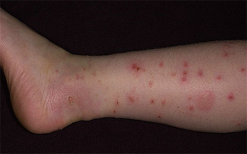 En cas de piqûres de puces multiples et récurrentes, un traitement vermifuge peut également être nécessaire.