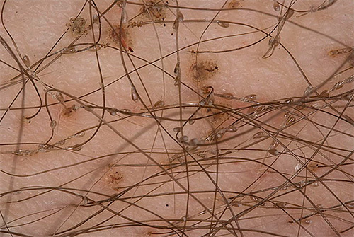 Et c'est ainsi que les parasites et leurs lentes regardent les cheveux directement dans leur habitat