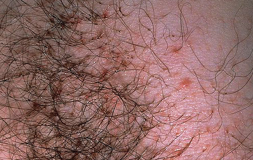 Et voici à quoi ressemblent les piqûres de poux du pubis avec une légère infection par des parasites